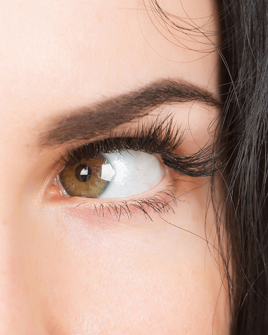 Squint surgery information and details