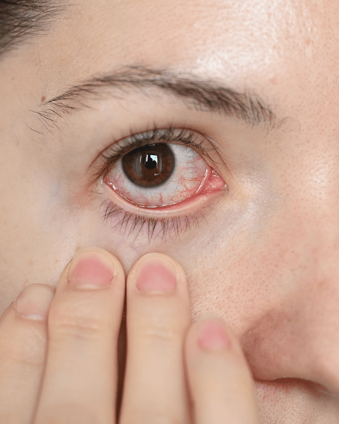 Uveitis treatment at The Eye Doctor, Huddersfield