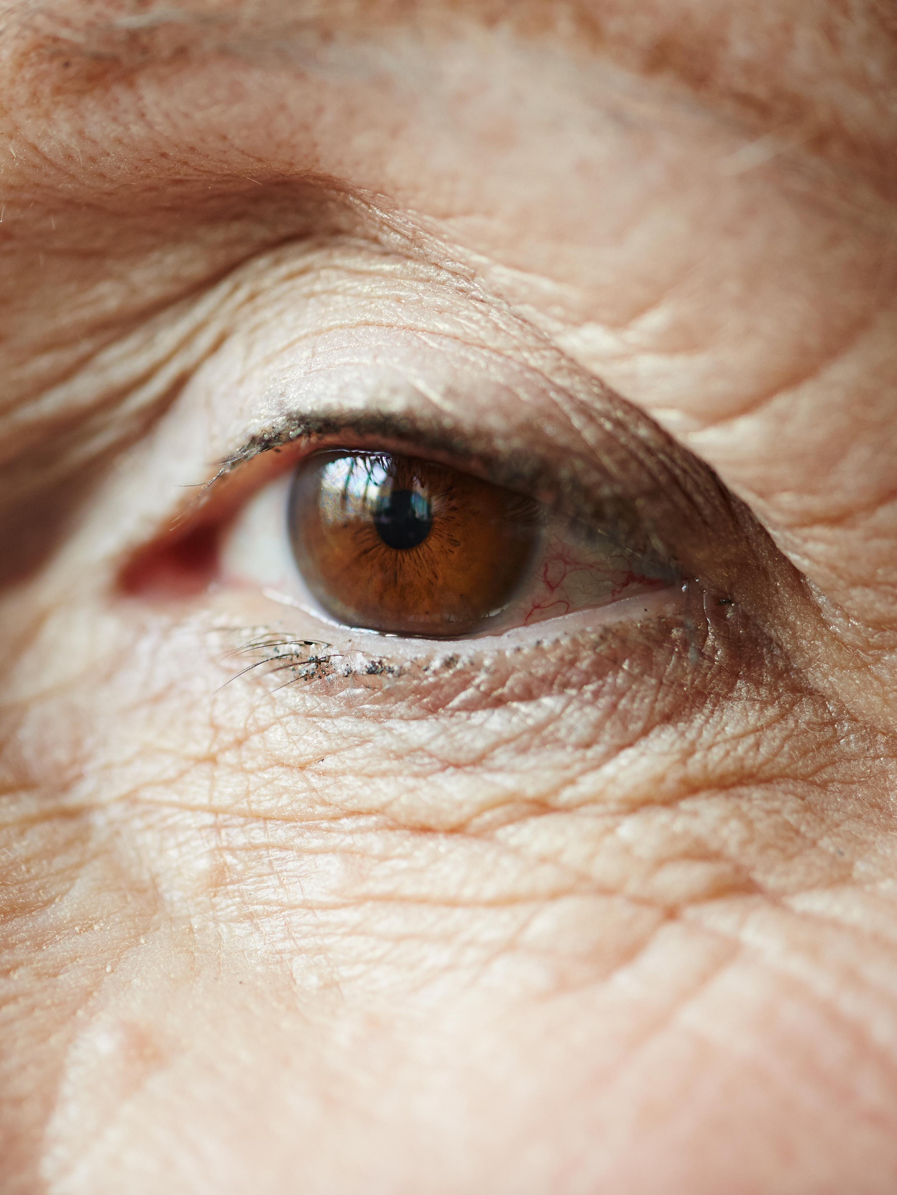 CAIRS KeraNatural keratoconus treatment at The Eye Doctor, Huddersfield